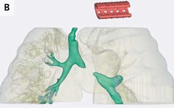 The CT scan of Giondriddo’s trachea and bronchi