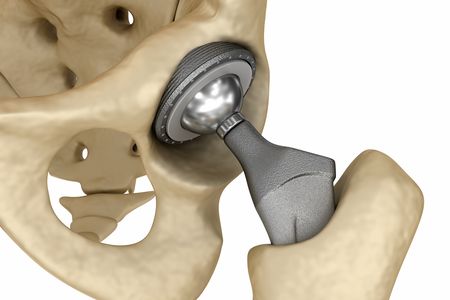 The Robodoc married robots and computers to revolutionize the complicated task of joint replacement surgery. 