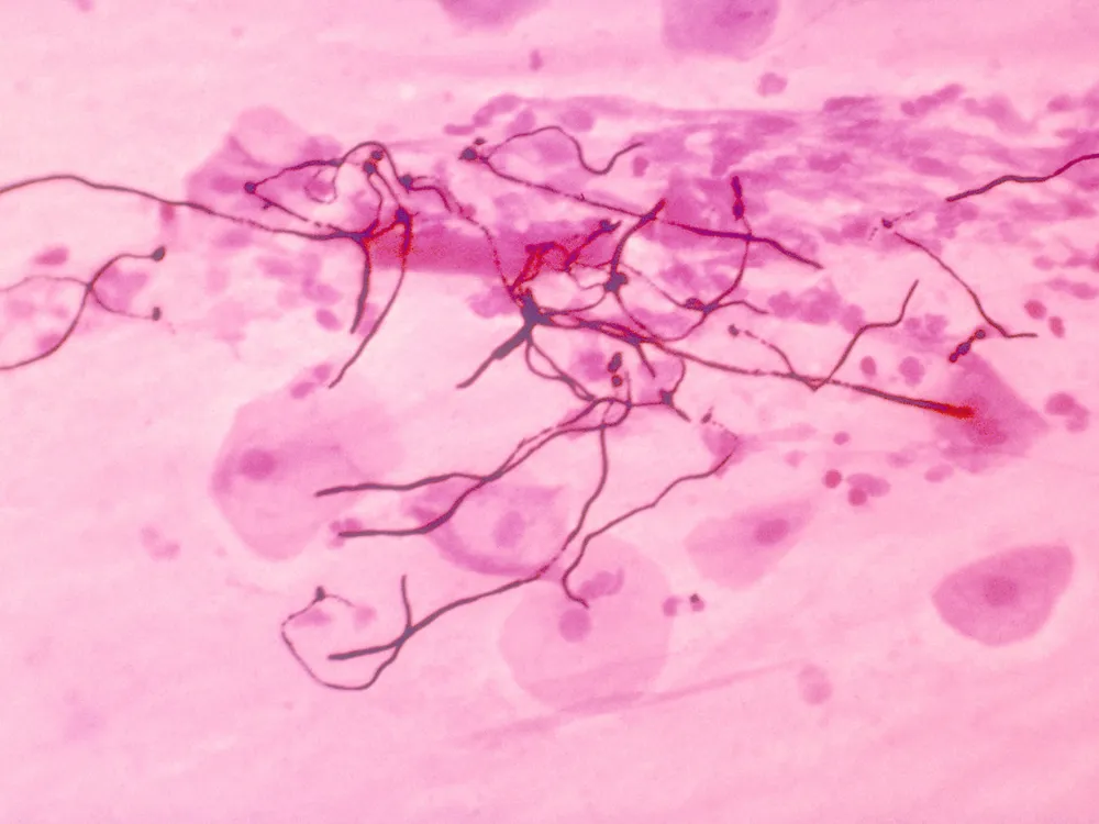 A stained micrograph revealing the presence of the fungus Candida albicans.