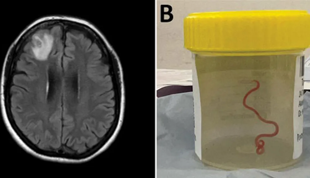 Side-by-side showing brain scan and worm in solution