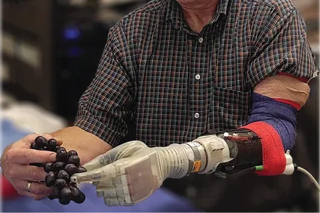 Keven Walgamott lost his left hand and part of his arm in an electrical accident 17 years ago