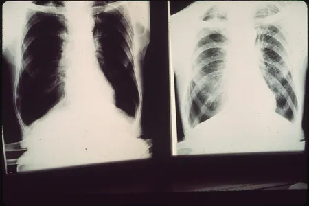 Black lung x-rays from a patient in Birmingham, Alabama, 1972