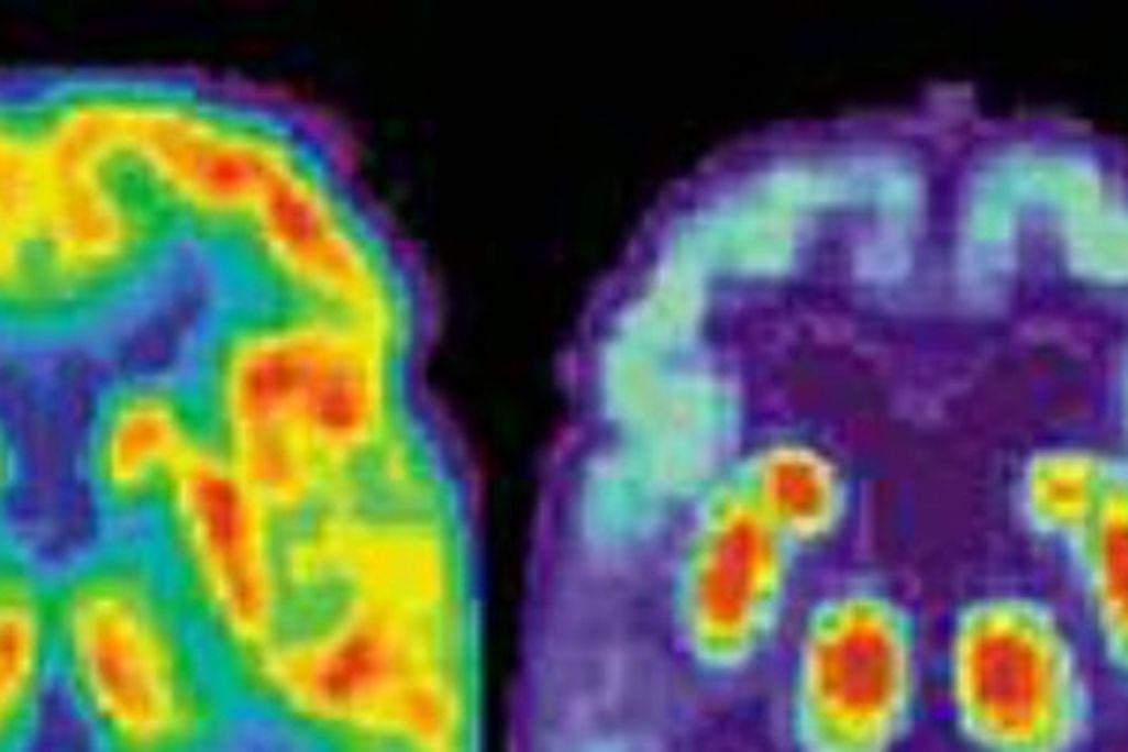 The brain scan on right shows Alzheimer’s damage.
