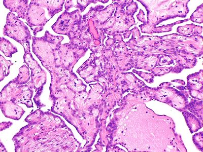 Micrograph of a well-differentiated papillary mesothelioma
