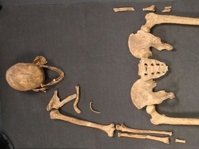 This 1,500 year old skeleton from the Anglo-Saxon town of Great Chesterford was a young man who had leprosy