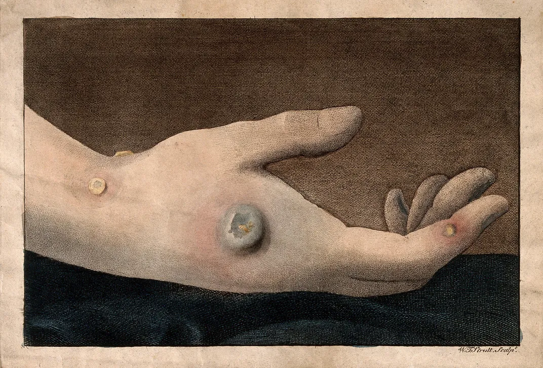 A human hand with smallpox pustules, as seen in a colored etching by W.T. Strutt