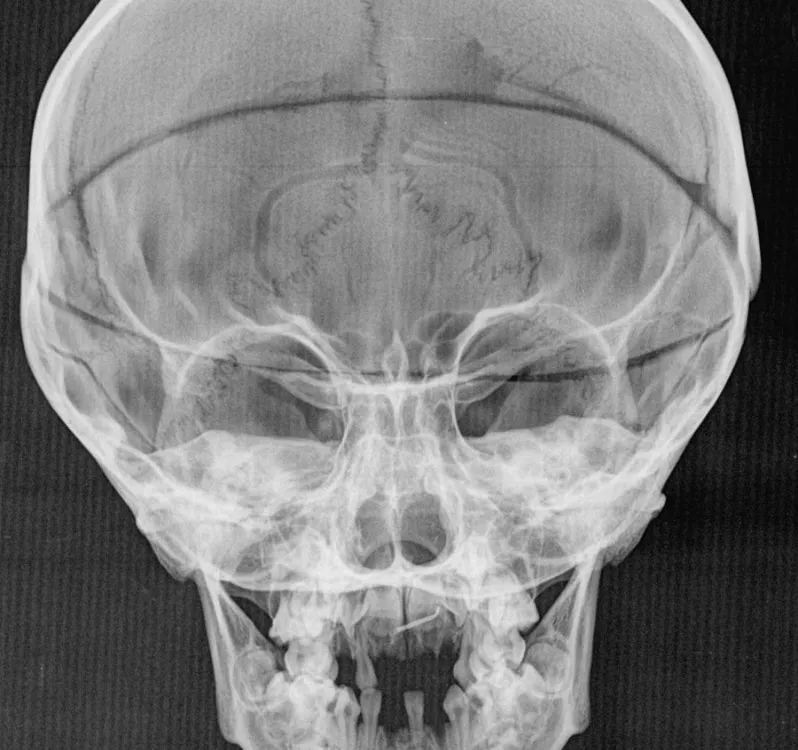 Five-year-old don Filippino’s abnormally swollen skull.