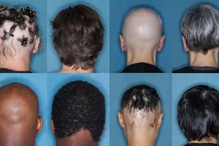 Before and after images of four study participants who recieved 36 weeks of treatment for severe alopecia areata with the drug baricitinib.