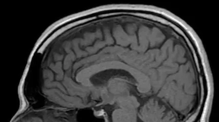 Researchers have found neurological abnormalities that persist long after the symptoms of a concussion have faded away.