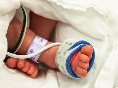 The baby, whose name is Itzmara, (Not Pictured) was delivered via C-section at 37 weeks, three weeks shy of full term because doctors feared that the fetus inside her, which was still growing, would crush her internal organs.