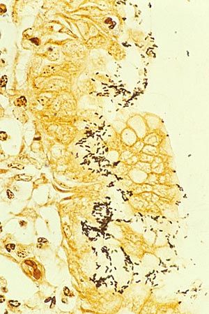 20110520090002ulcer_art.jpg