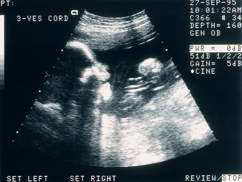 A sonogram of a human fetus.