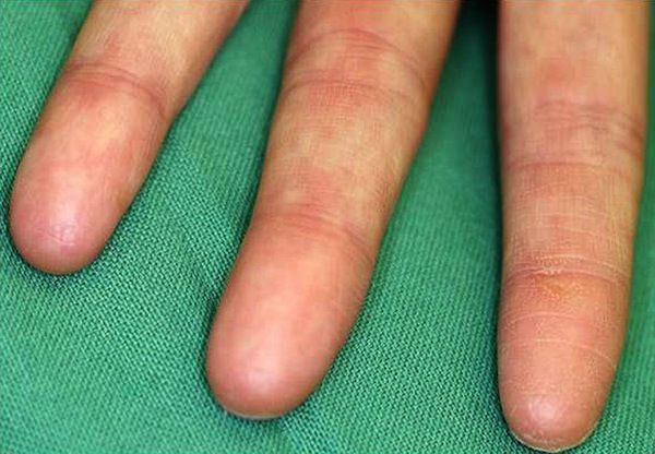 Adermatoglyphia: The Genetic Disorder Of People Born Without Fingerprints