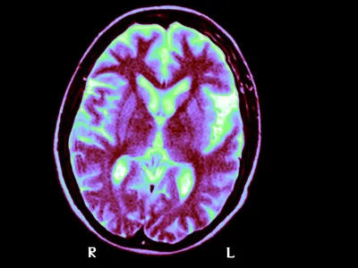 An MRI of a brain of a person with Alzheimer&#39;s disease. A new study suggests having two copies of a genetic variant called APOE4 is a cause of the disease, not just a risk factor for it.