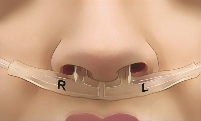 an illustration of a tube in a person's nose
