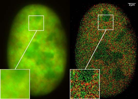 GFP in Bone Cancer Cell