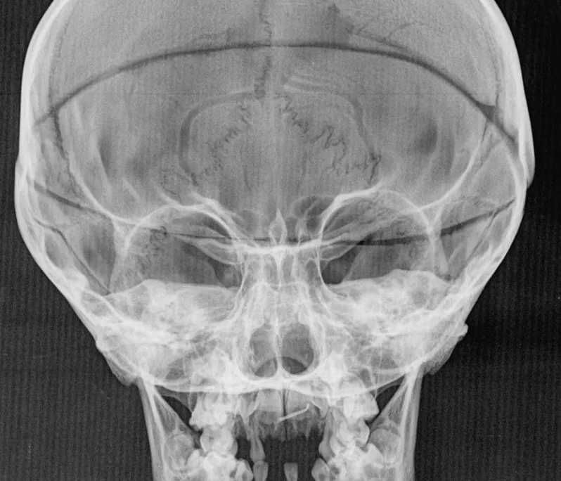Five-year-old don Filippino’s abnormally swollen skull.