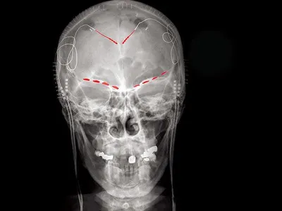 This X-ray of a study participant shows recording electrodes placed in the brain in red, as well as two controllers implanted in the shoulders.