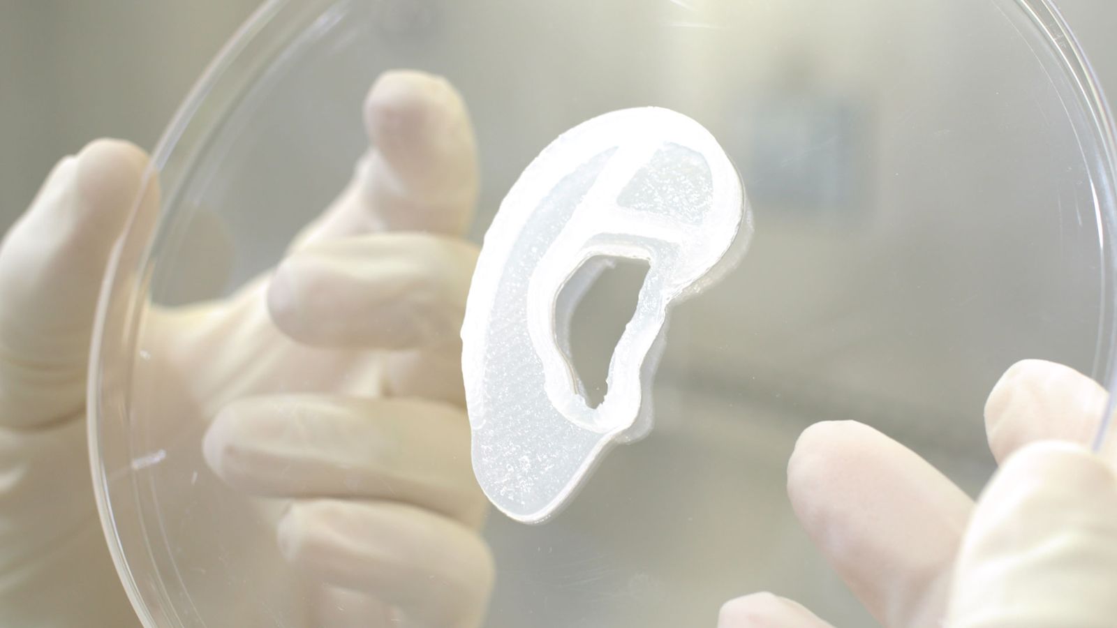 Surgeons Transplant 3-D-Printed Ear Made From Patient’s Own Cells