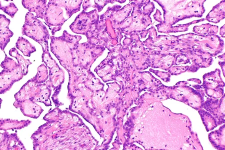 Micrograph of a well-differentiated papillary mesothelioma