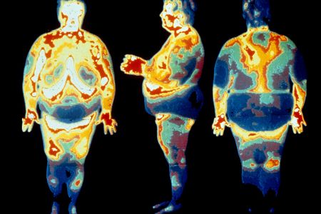 Thermogram images of an obese woman.