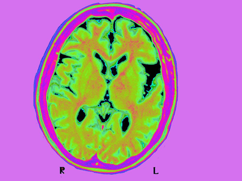 An MRI of the brain of a person with Alzheimer's