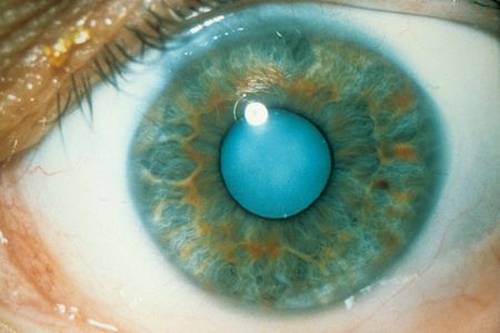 Cataract of the human eye