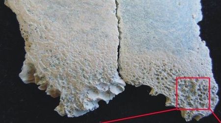 Skull fragments from a 2-year-old child (exterior view, top left; interior view, top right) that died 1.5 million years ago contain evidence of anemia. The blood disorder can lead to very porous bone (bottom left, right).