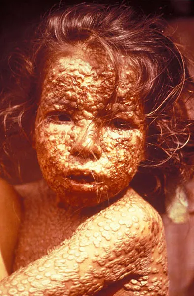 Smallpox child