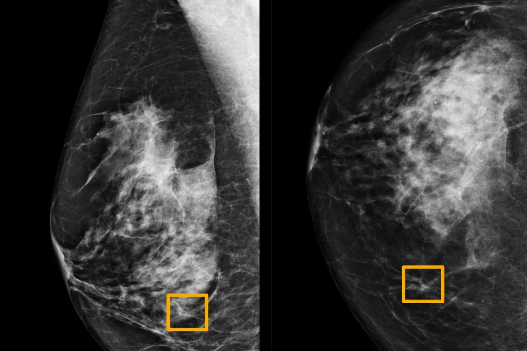 Mammogram with yellow boxes where AI identified possible breast cancer