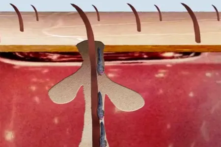 Two species of mites make their home in the hair follicles on your face. 