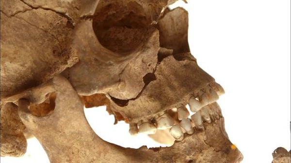 Preview thumbnail for What the Traumatic Injuries on Richard III's Skeleton Reveal