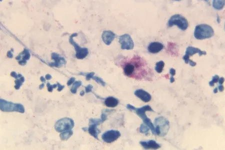 A stained tissue sample from 1967 reveals the presence of  Chlamydia psittaci bacteria. 