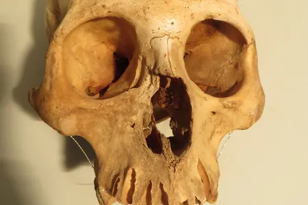 The cranium of an adult male, likely 25 to 30 years old, shows healed trauma affecting the upper jaw. The injury was probably caused by a punch from another individual in a fight.