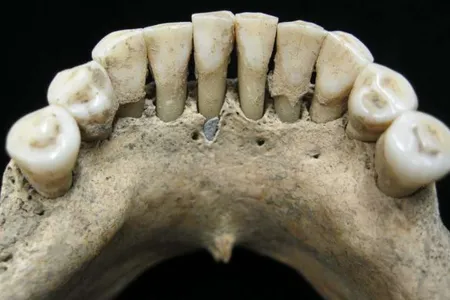 Dental calculus on the lower jaw a medieval woman entrapped lapis lazuli pigment. 