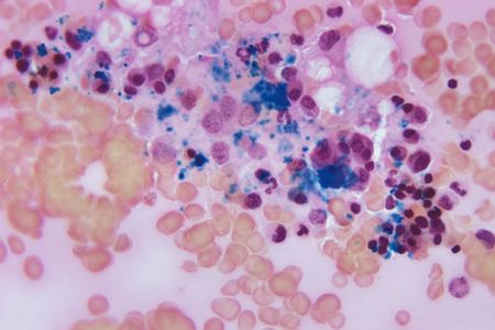 An image taken through a microscope of bone marrow tissue. To cure the patient of HIV, researchers destroyed his bone marrow cells and gave him a donation of stem cells with an HIV-resistant mutation.