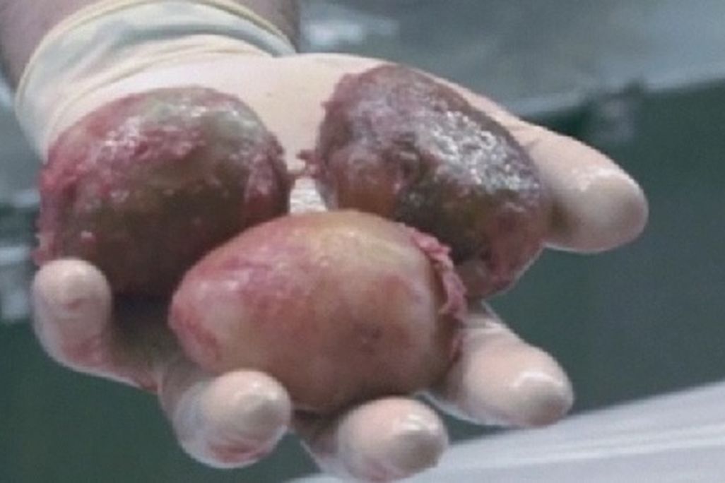 Three of the 87 record eggs removed from the python