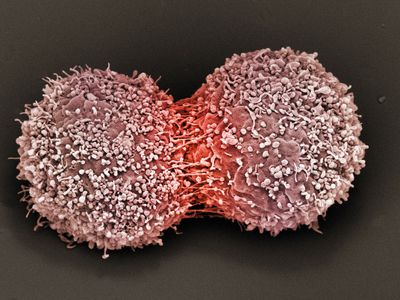 Breast cancer cells dividing.