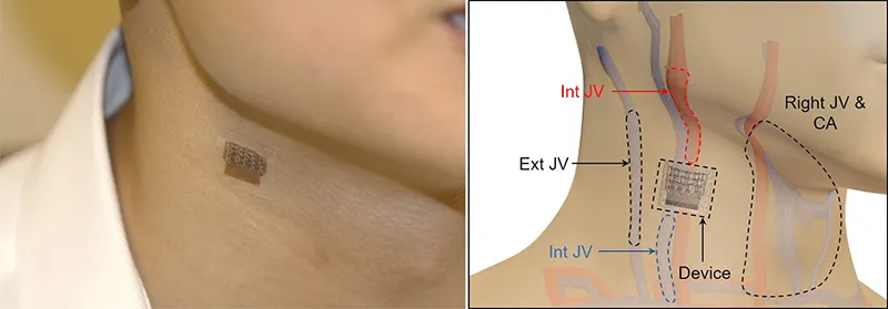 This Ultrasound Patch Monitors Blood Pressure in Deep Arteries