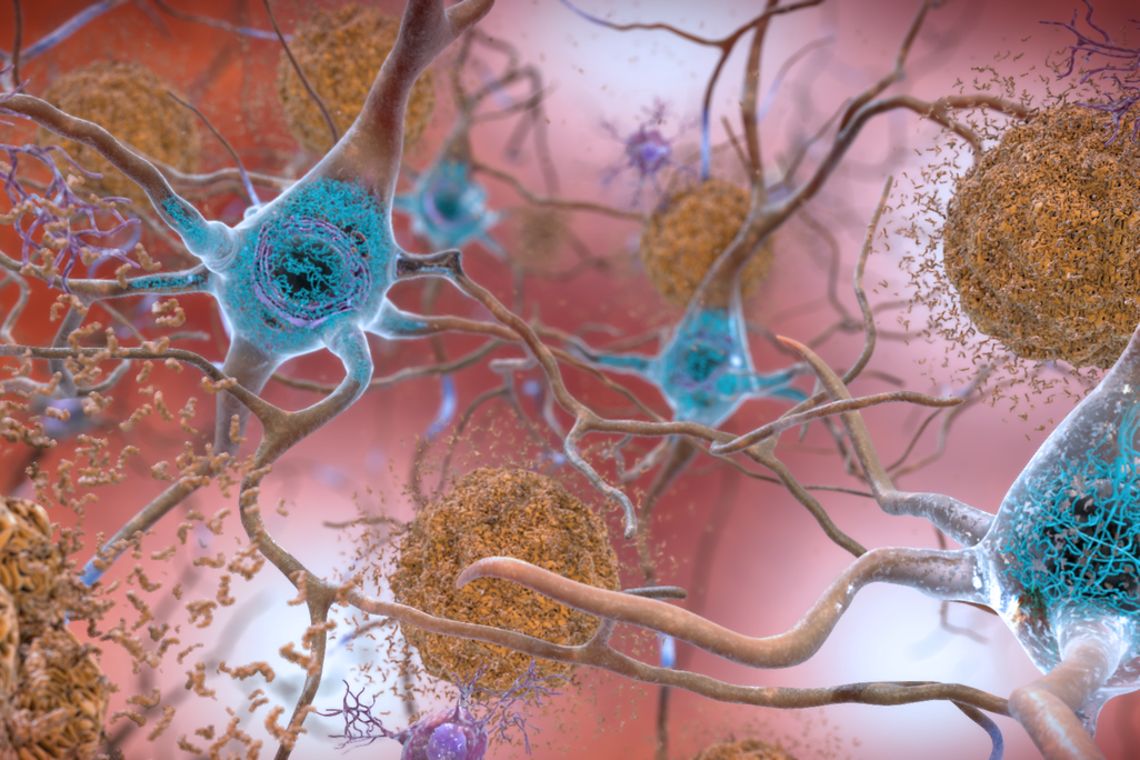 amyloid and tau in the brain