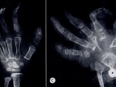 The X-ray on the left shows one of the girls’ hands at 2-and-a-half-years old. On the right, her same hand is shown at 12-years old.