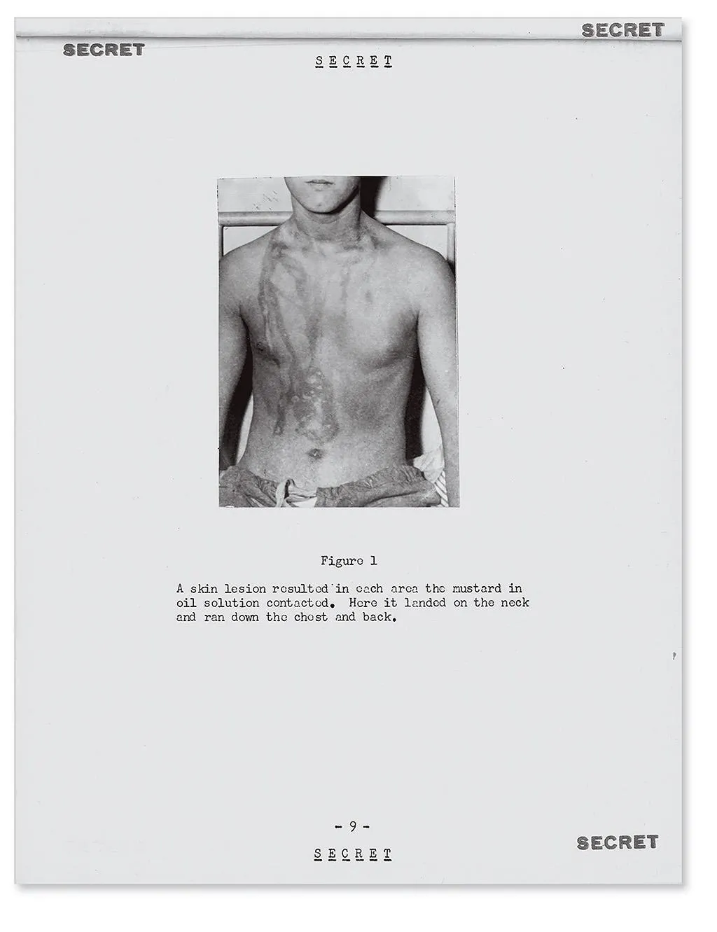 A survivor of the Bari attack. Widespread symptoms of contamination quickly led Stewart Alexander to deduce that poison gas had become mixed in the harbor water.