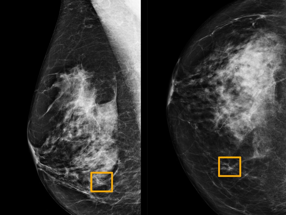 Mammogram with yellow boxes where AI identified possible breast cancer