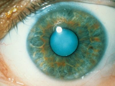 Cataract of the human eye