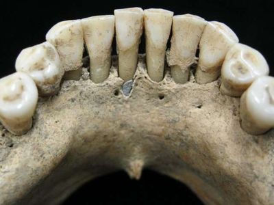 Dental calculus on the lower jaw a medieval woman entrapped lapis lazuli pigment. 