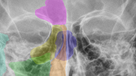 This X-ray of a human skull highlights the main nasal cavity (orange) and the sinuses: frontal (pink), ethmoid (yellow), maxillary (green) and sphenoid (purple). Asian apes do not have frontal or ethmoid sinuses.