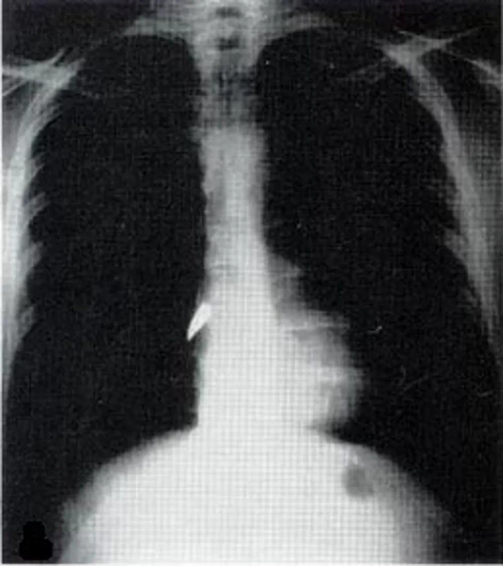 X-ray of a bullet in the heart