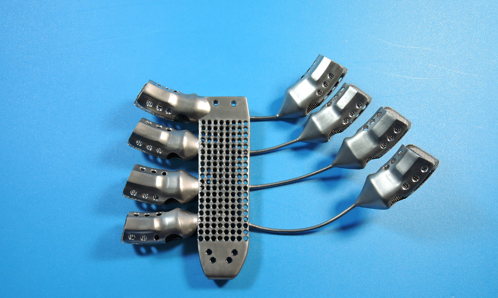 3-D Printer Uses Metal To Make Custom Rib Cage For Cancer Patient