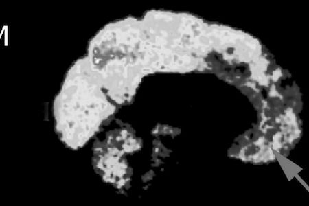 Compared to a control brain (top), neuroscientist James Fallon’s brain (bottom) shows significantly decreased activity in areas of the frontal lobe linked to empathy and morality—anatomical patterns that have been linked with psychopathic behavior.
