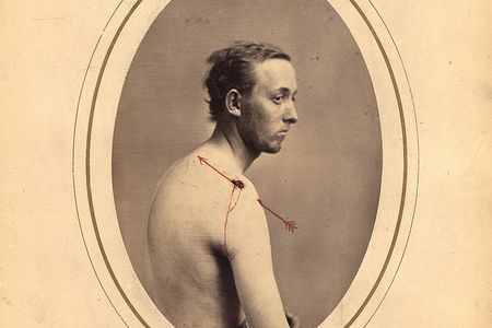 Peter Strien was 21 years old when he was wounded at the battle of Fort Steadman. 